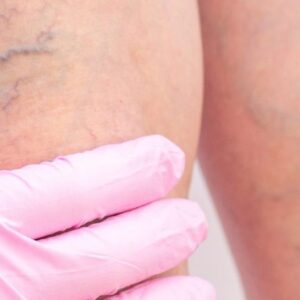 Vascular Lesions