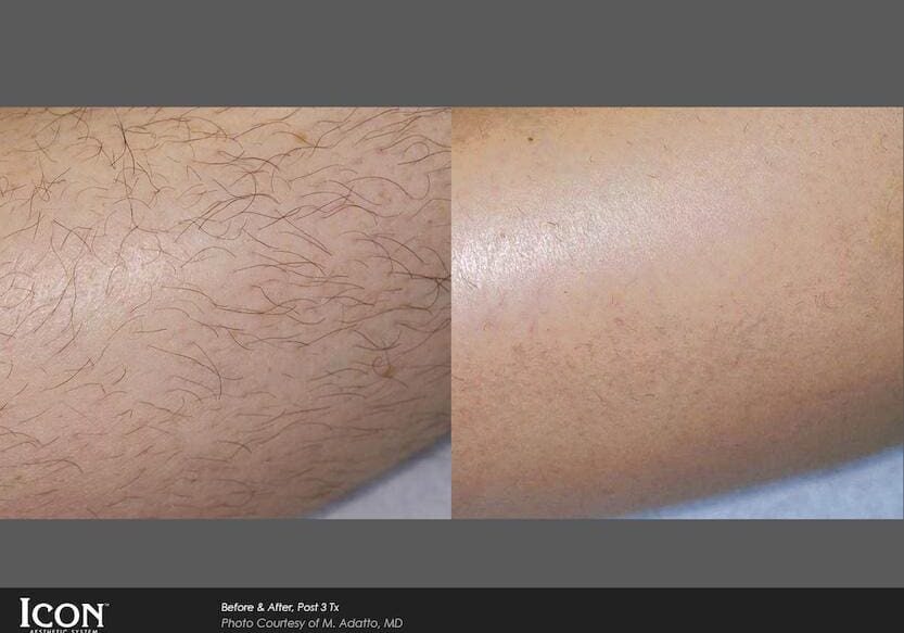Before and after hair removal on skin.