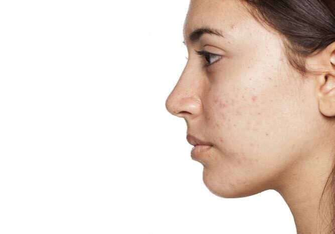 Close-up profile of a young woman with acne on her skin.