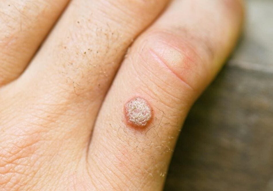 Close-up of a hand with a raised wart on a finger.