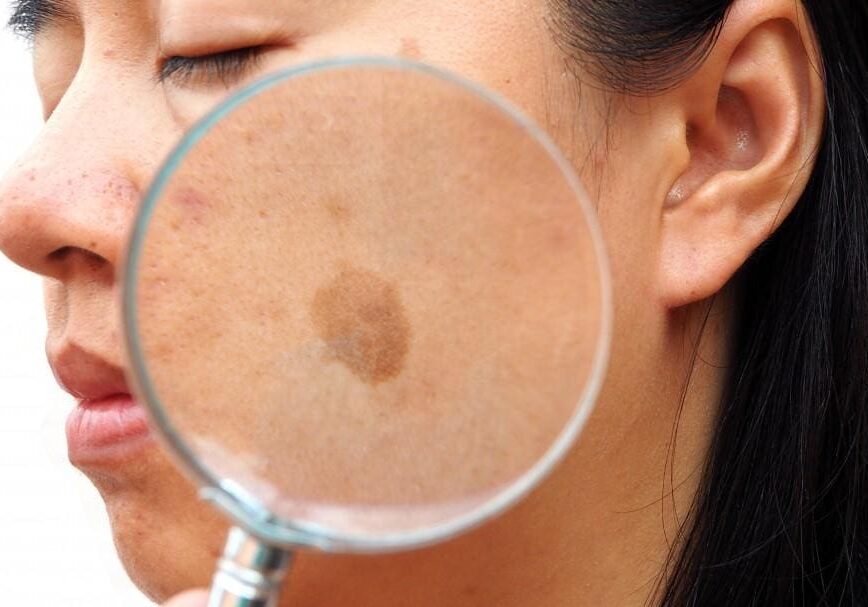 Close-up of facial skin with a brown spot under a magnifying glass.