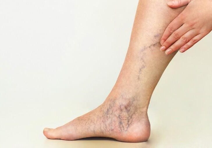 Close-up of a leg with visible varicose veins and spider veins.