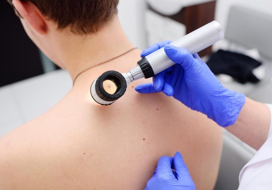 Dermatologist examining moles on a patient's back with a dermatoscope.