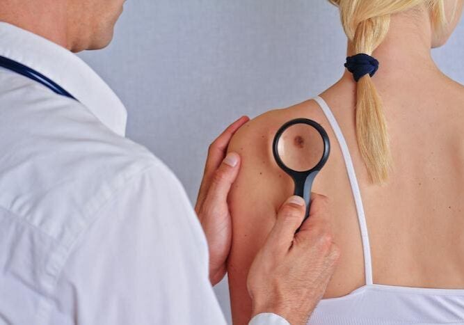 Doctor examining a mole on a patient's back with a magnifying glass.