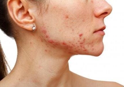 Close-up of a person's face with acne and skin blemishes.