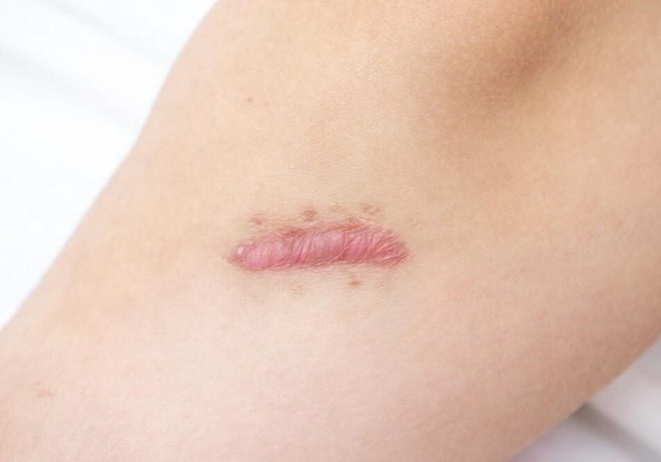 Close-up of a healing scar on skin with slight redness.
