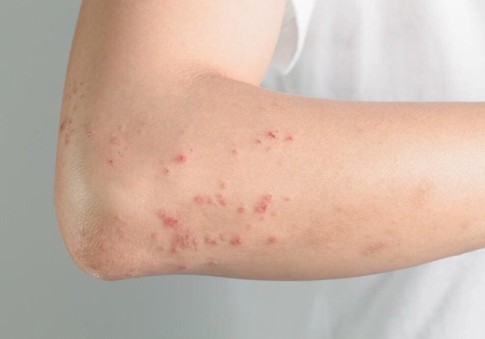 Close-up of red, irritated skin rash on a person's arm.