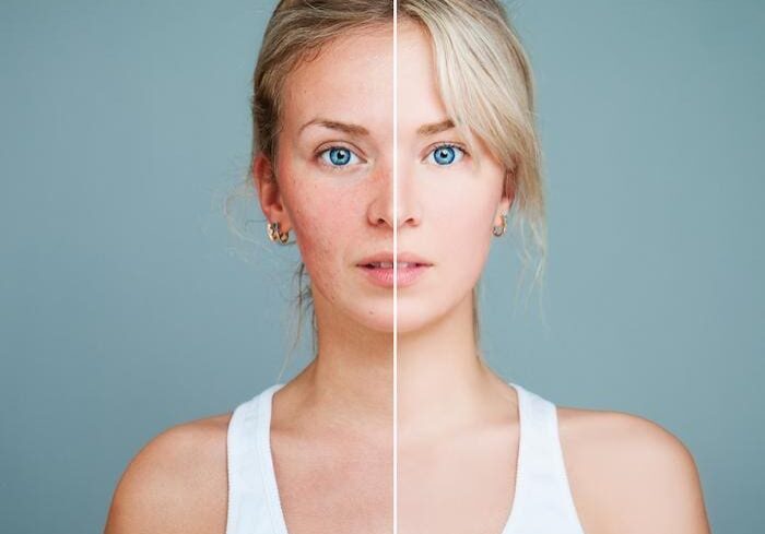 Split image showing a woman's face with and without skin treatment.