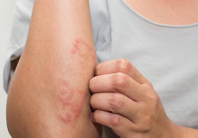 Close-up of an arm with red, irritated skin and a hand scratching it.