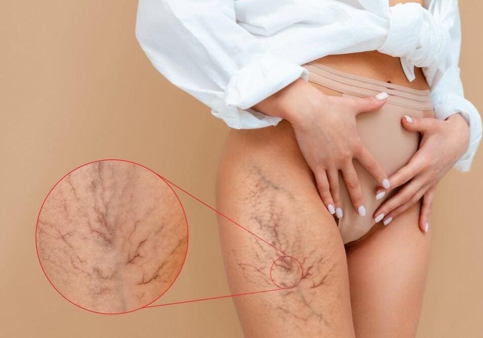 Close-up of spider veins on a woman's thigh with an inset showing detailed veins.
