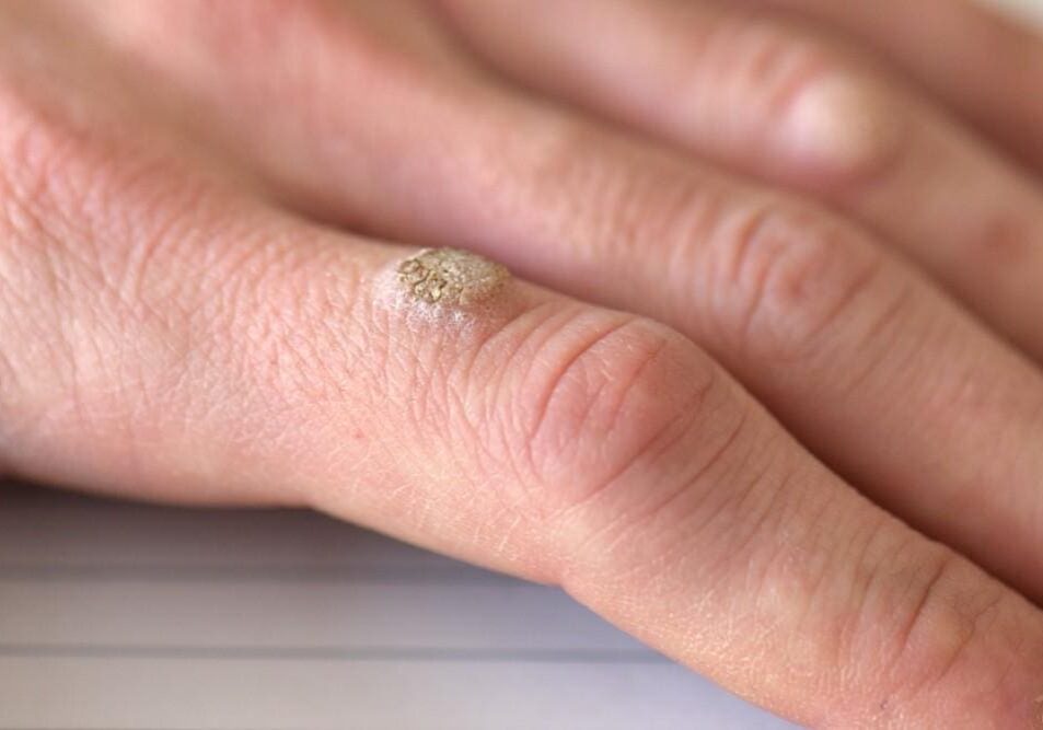 A close-up of a hand with a wart on the finger.