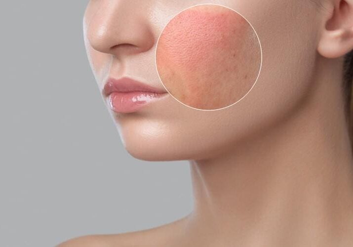 Close-up of facial redness and irritation on a woman's cheek.