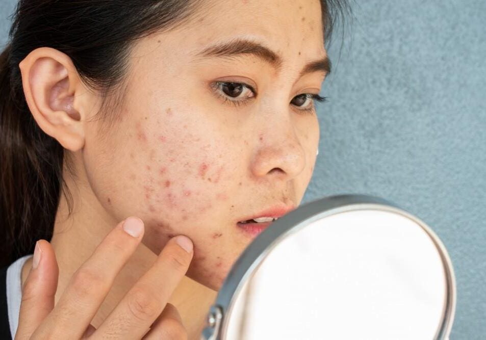 Woman examining acne and blemishes on her face in a mirror.