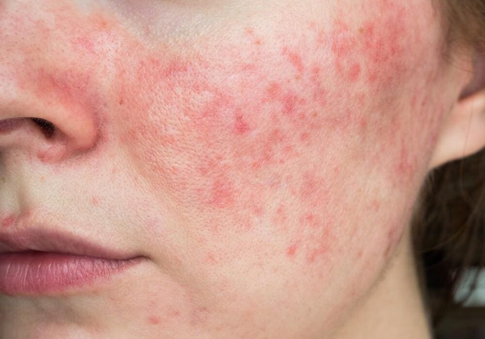 Close-up of a person's cheek with red acne and inflammation.