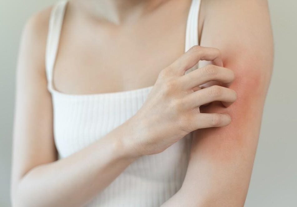 Woman scratching itchy, red arm rash.
